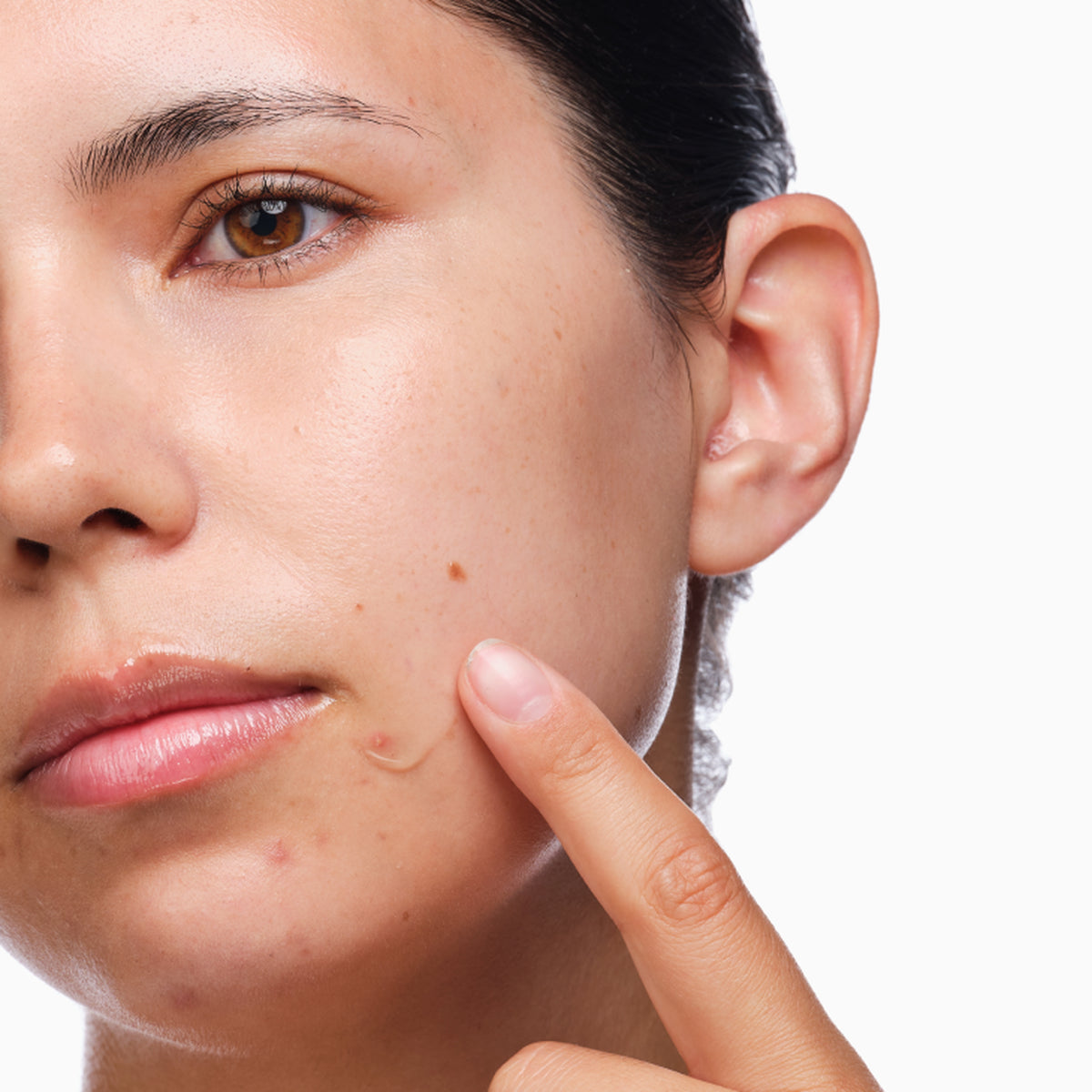 The Ordinary | The Acne Set